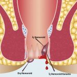 Hemoroid (Basur) Nedir? Tedavisi Nasıl Olur?